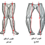 تقوس الساقين